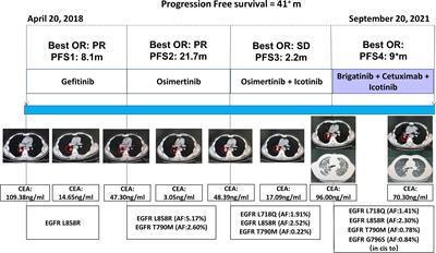 Case Report: Durable Response to the Combination of Brigatinib and Cetuximab Plus Icotinib in a NSCLC Patient Harboring EGFR L858R-T790M-cis-G796S and L718Q Resistance Mutations Following Progression With Osimertinib
